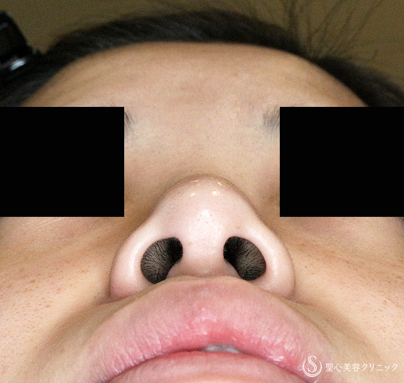 【20代女性・特徴的な鼻をスマートに】小鼻縮小術+α・鼻尖縮小＋PCLドーム ・Gメッシュ（3ヶ月後） Before 