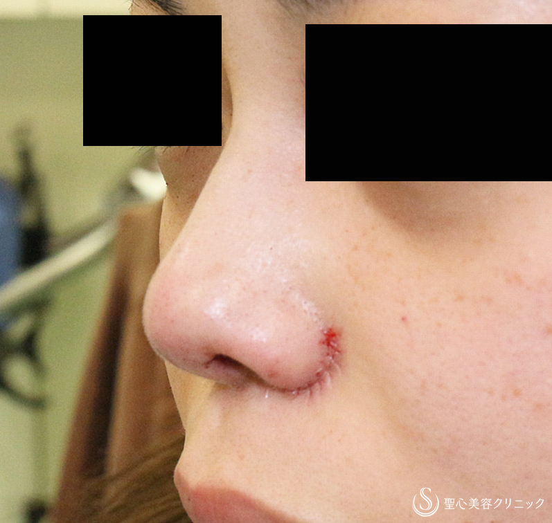 【20代女性・特徴的な鼻をスマートに】小鼻縮小術+α・鼻尖縮小＋PCLドーム ・Gメッシュ（3ヶ月後） After 