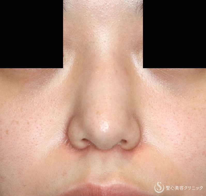 【20代女性・特徴的な鼻をスマートに】小鼻縮小術+α・鼻尖縮小＋PCLドーム ・Gメッシュ（3ヶ月後） After 