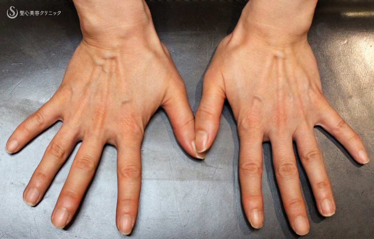【40代女性・手の甲は年齢を隠せない】プレミアムPRP皮膚再生療法（2年4ヶ月後） Before 
