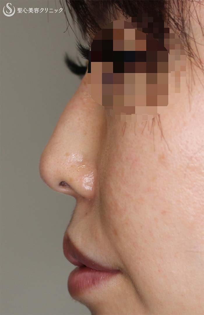 【40代女性・お鼻に変化を！！】鼻柱基部プロテーゼ（術後9ヶ月） Before 