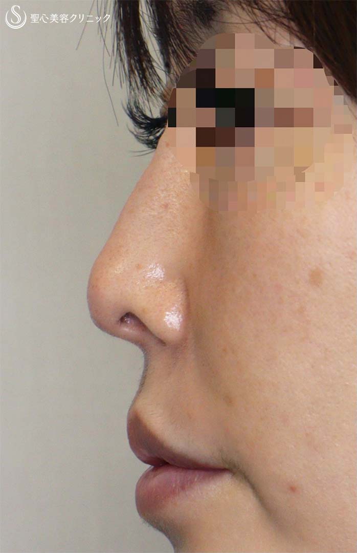 【40代女性・お鼻に変化を！！】鼻柱基部プロテーゼ（術後9ヶ月） After 