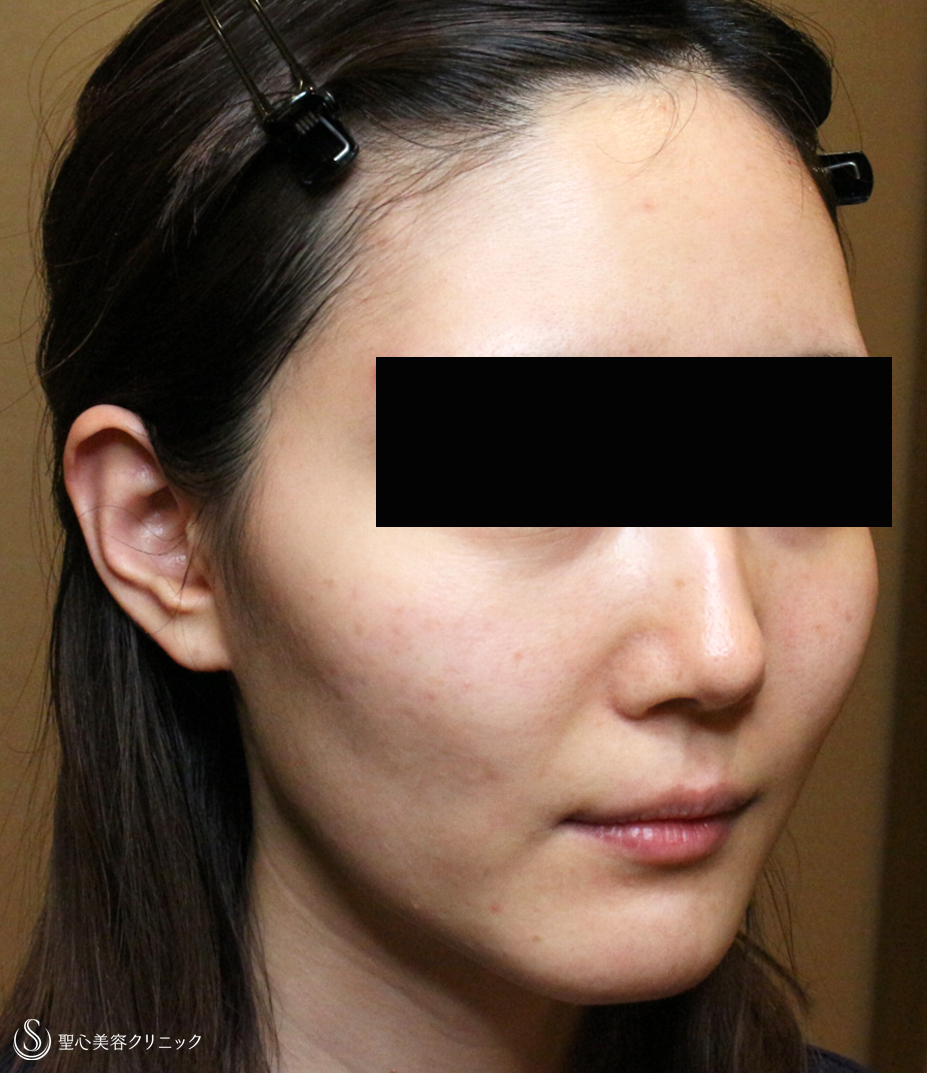 30代女性 輪郭を整えて美人度アップ プレミアムprp皮膚再生療法 直後 3ヶ月後 症例写真 美容整形 美容外科なら聖心美容クリニック