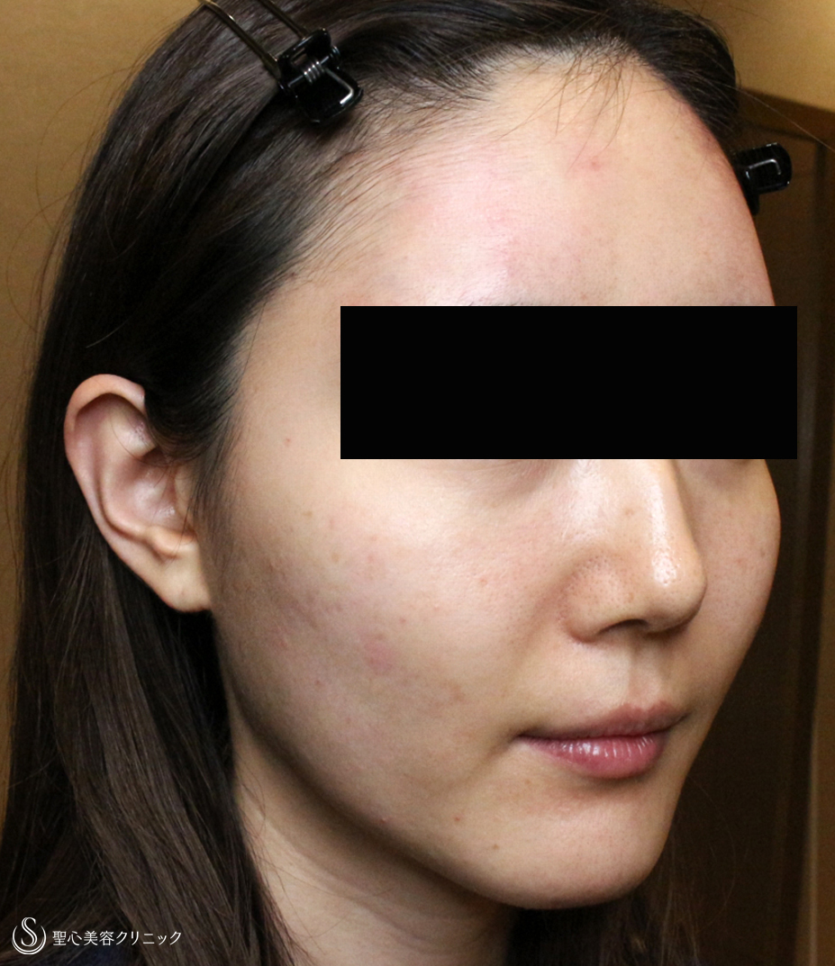 【30代女性・輪郭を整えて美人度アップ】プレミアムPRP皮膚再生療法（直後〜3ヶ月後） Before 