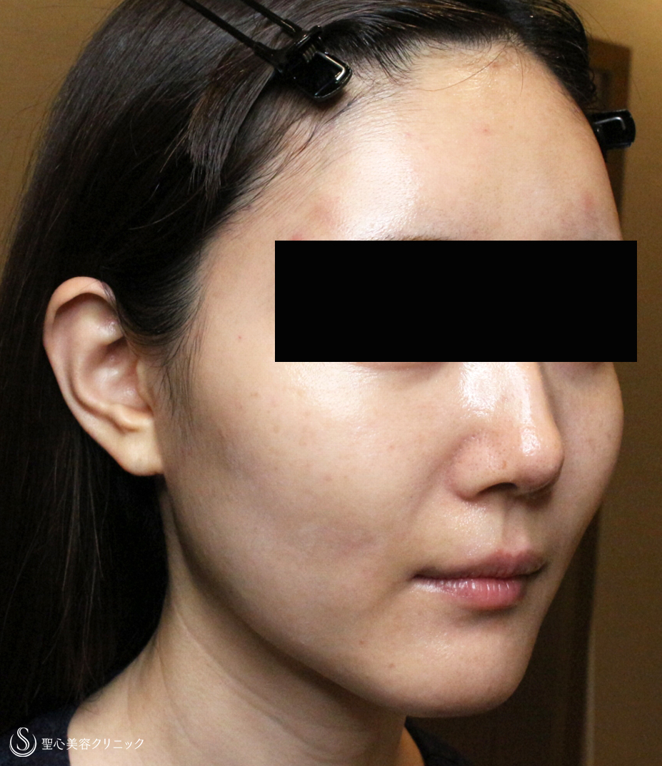【30代女性・輪郭を整えて美人度アップ】プレミアムPRP皮膚再生療法（直後〜3ヶ月後） After 