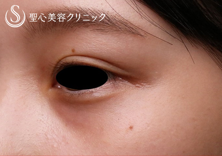 【20代女性・目の下のくま】プレミアムPRP皮膚再生療法（9ヶ月後） Before 