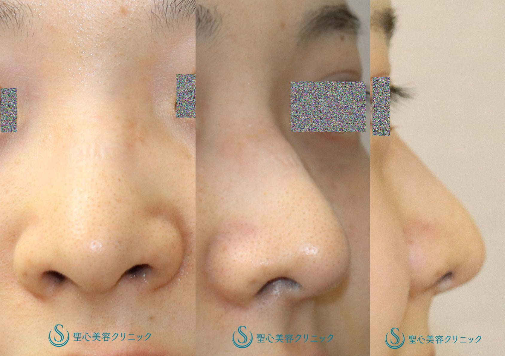 【20代女性・鼻先を高く】鼻尖縮小＋鼻尖形成（耳介軟骨移植）（術後1ヶ月） Before 
