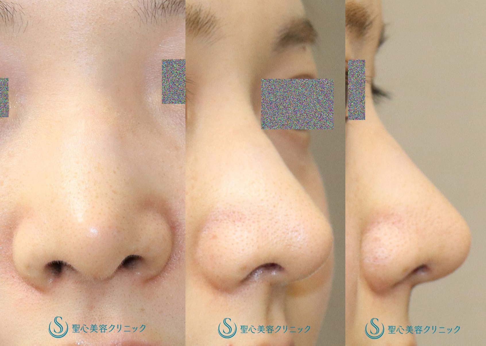 【20代女性・鼻先を高く】鼻尖縮小＋鼻尖形成（耳介軟骨移植）（術後1ヶ月） After 