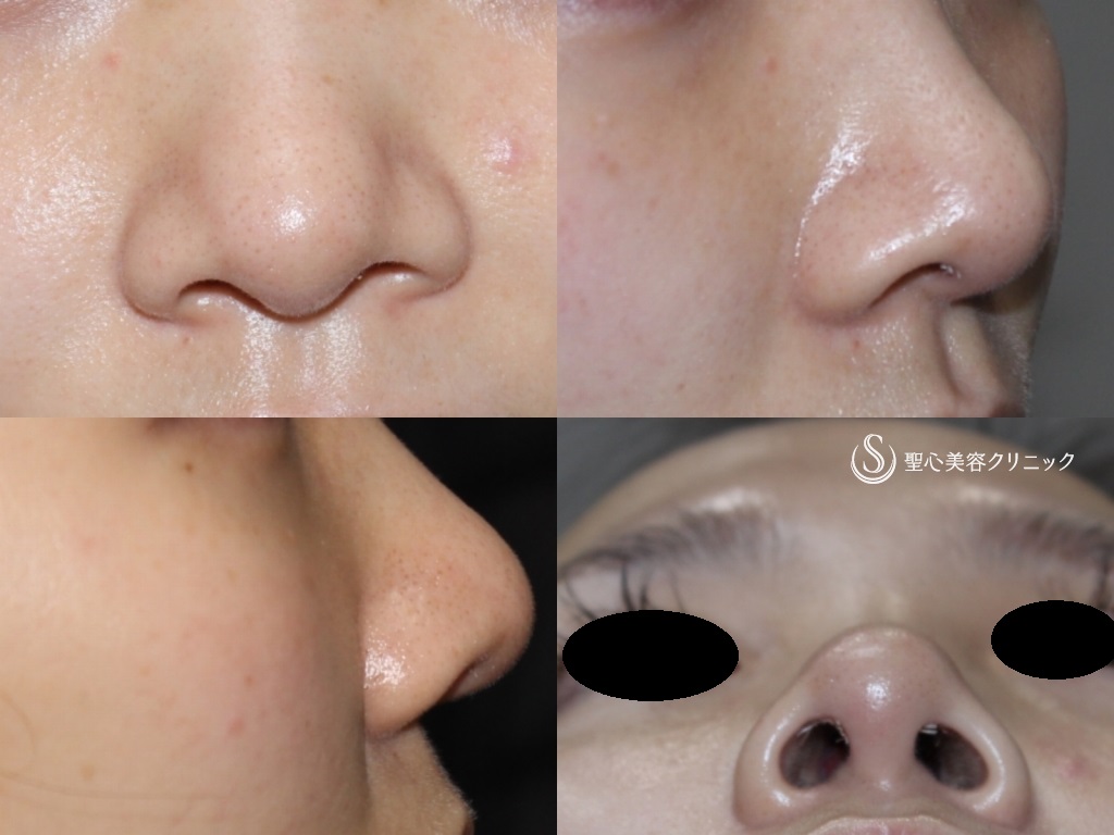 【20代女性・細くて綺麗な鼻先にしたい】鼻尖縮小+鼻尖形成（3DPCLドーム）（1ヶ月後） Before 