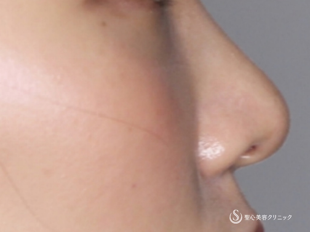 【20代女性・細くて綺麗な鼻先にしたい】鼻尖縮小+鼻尖形成（3DPCLドーム）（1ヶ月後） After 