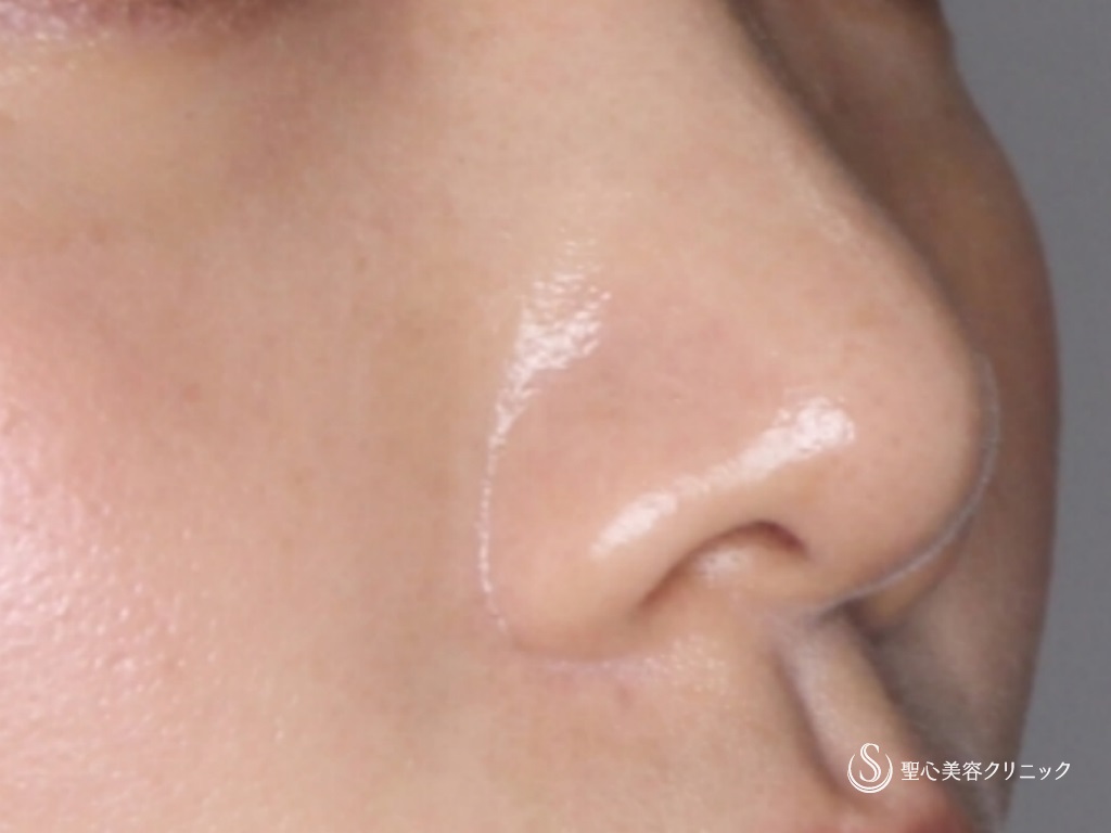 【20代女性・細くて綺麗な鼻先にしたい】鼻尖縮小+鼻尖形成（3DPCLドーム）（1ヶ月後） After 