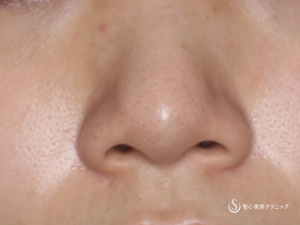 【20代女性・細くて綺麗な鼻先にしたい】鼻尖縮小+鼻尖形成（3DPCLドーム）（1ヶ月後） Before 