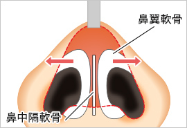 ②鼻翼軟骨を切り開く