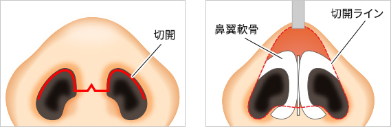 ➀切開