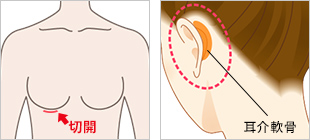 耳介軟骨/肋軟骨の採取