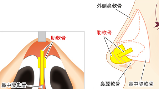 ③肋軟骨または耳介軟骨で支柱を立てて延長する