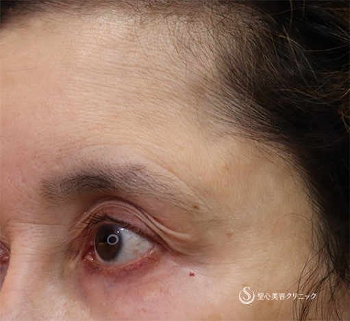 【50代女性・目の上のくぼみ】プレミアムPRP皮膚再生療法（術後5カ月） Before 