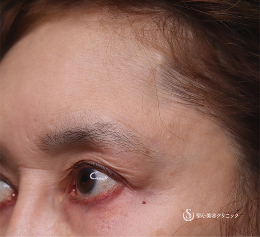 【50代女性・目の上のくぼみ】プレミアムPRP皮膚再生療法（術後5カ月） After 
