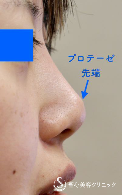 【女性・他院修正】鼻尖縮小術、耳介軟骨移植（直後） Before 