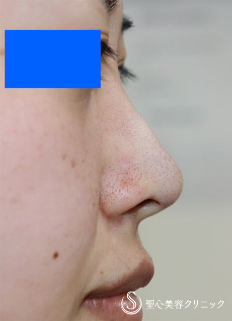 【女性・他院修正】鼻尖縮小術、耳介軟骨移植（直後） After 