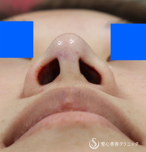 【女性・他院修正】鼻尖縮小術、耳介軟骨移植（直後） After 