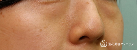 【40代女性・目の下のくま】プレミアムPRP皮膚再生療法（術後3ヶ月） Before 