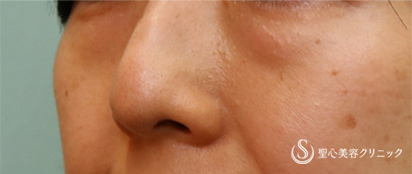 【40代女性・目の下のくま】プレミアムPRP皮膚再生療法（術後3ヶ月） Before 