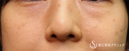 【40代女性・目の下のくま】プレミアムPRP皮膚再生療法（術後3ヶ月） After 