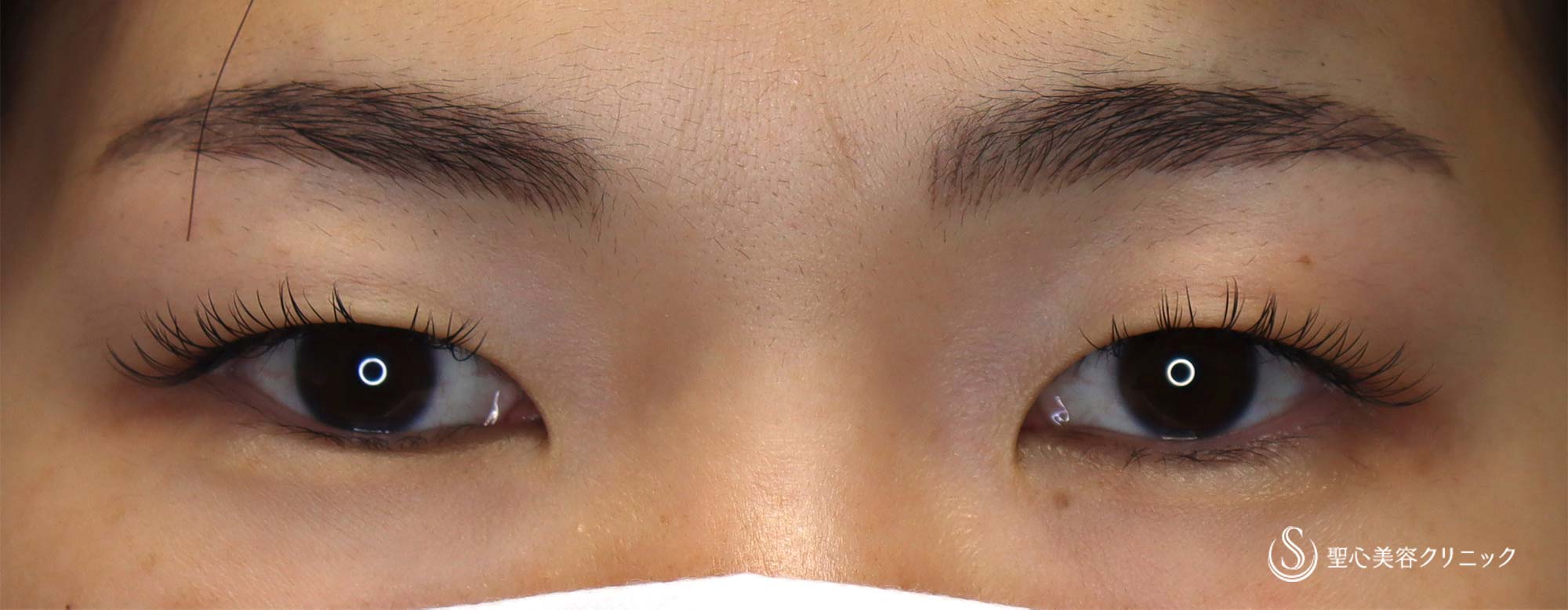 30代女性 アートメイクと眉下切開の相性は抜群 眉下リフト 術後1ヶ月 症例写真 美容整形 美容外科なら聖心美容クリニック 30代女性 アートメイクと眉下切開の相性は抜群 眉下リフト 術後1ヶ月 症例写真 美容整形 美容外科なら聖心美容クリニック