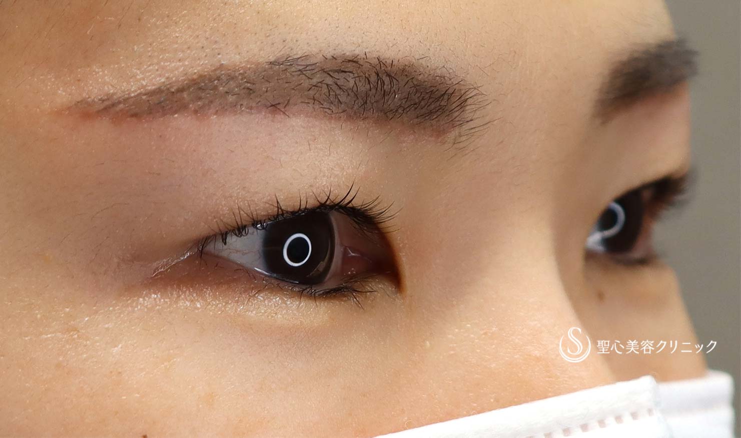 30代女性 アートメイクと眉下切開の相性は抜群 眉下リフト 術後1ヶ月 症例写真 美容整形 美容外科なら聖心美容クリニック 30代女性 アートメイクと眉下切開の相性は抜群 眉下リフト 術後1ヶ月 症例写真 美容整形 美容外科なら聖心美容クリニック