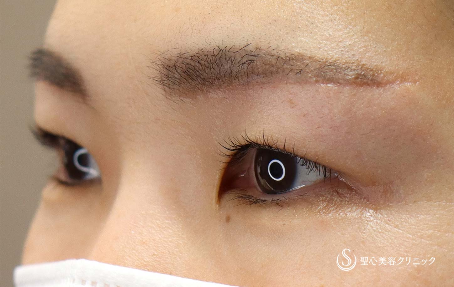 30代女性 アートメイクと眉下切開の相性は抜群 眉下リフト 術後1ヶ月 症例写真 美容整形 美容外科なら聖心美容クリニック 30代女性 アートメイクと眉下切開の相性は抜群 眉下リフト 術後1ヶ月 症例写真 美容整形 美容外科なら聖心美容クリニック