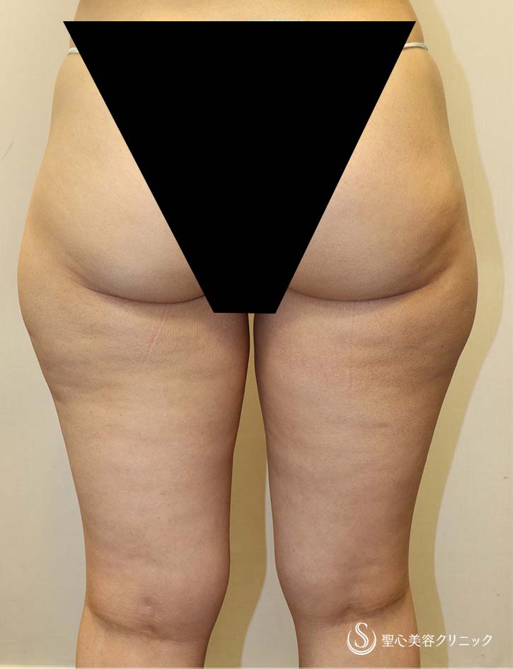 【40代女性・下半身だけ太り...を解決】ベイザーリポ脂肪吸引（術後1ヶ月） Before 