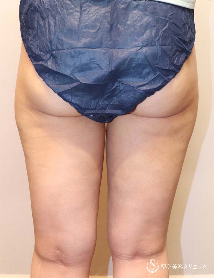 【40代女性・下半身だけ太り...を解決】ベイザーリポ脂肪吸引（術後1ヶ月） After 