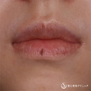 【20代女性・唇のしみ】Picoレーザー（術後4ヶ月＆再処置3ヶ月） Before 