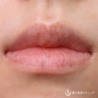 【20代女性・唇のしみ】Picoレーザー（術後4ヶ月＆再処置3ヶ月） After 