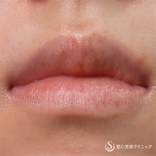 【20代女性・唇のしみ】Picoレーザー（術後4ヶ月＆再処置3ヶ月） After 