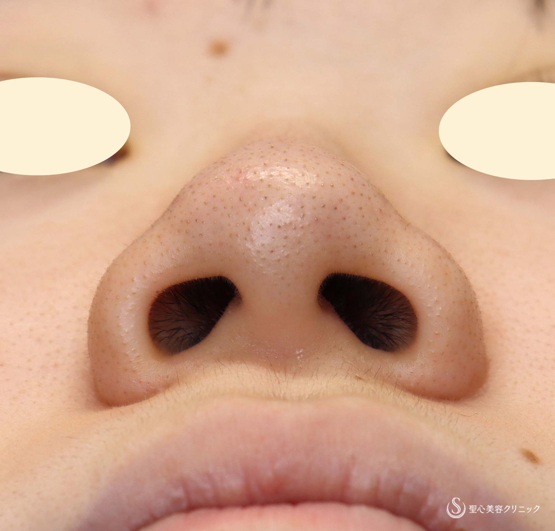 【20代女性・鼻筋を通す】鼻プロテーゼ＋骨削り＋鼻尖縮小（術後3ヶ月） Before 