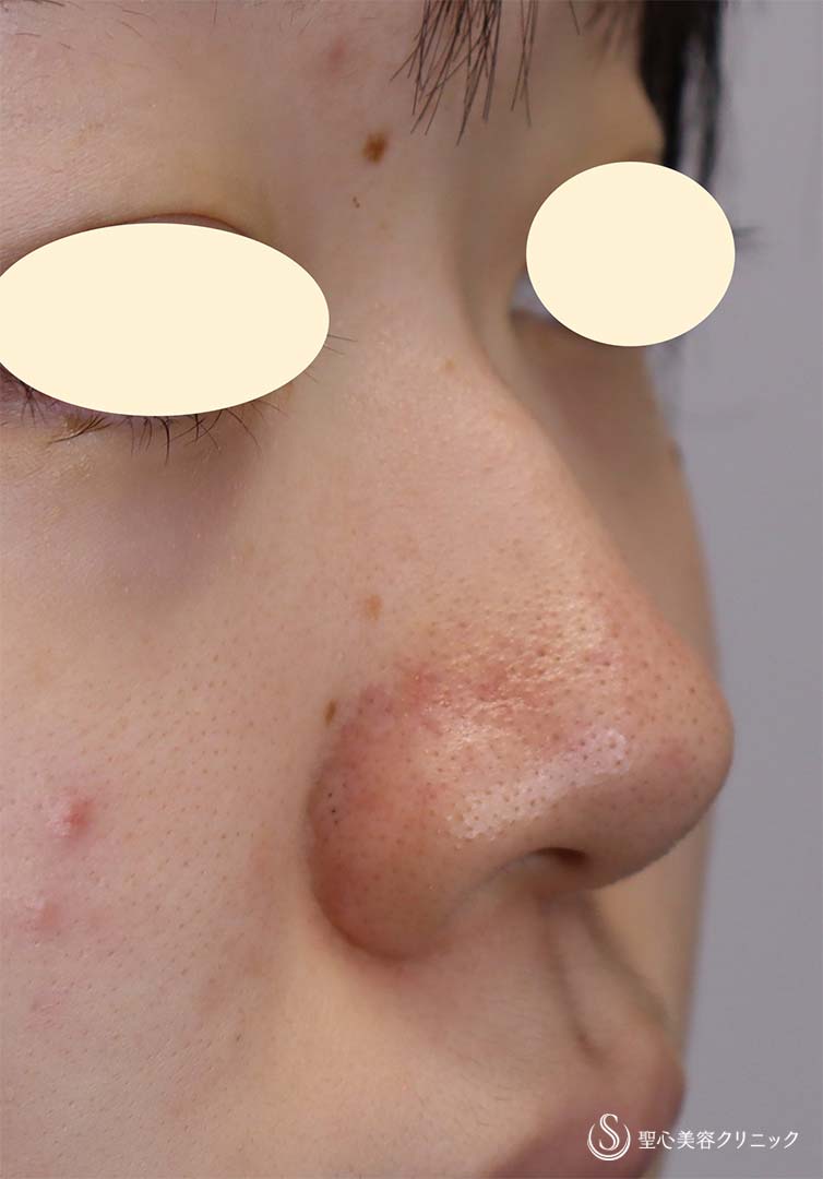【20代女性・鼻筋を通す】鼻プロテーゼ＋骨削り＋鼻尖縮小（術後3ヶ月） Before 