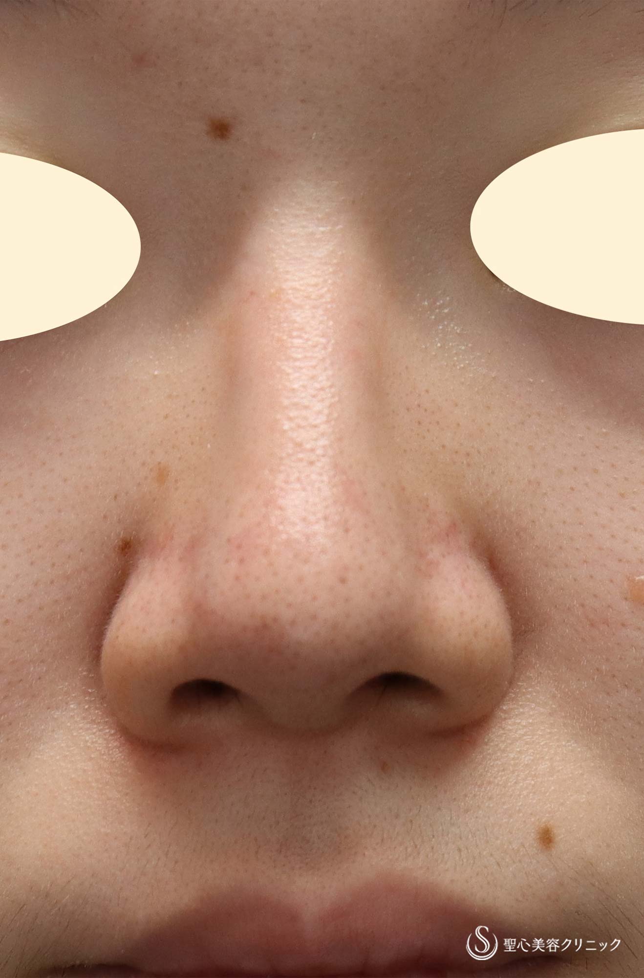 【20代女性・鼻筋を通す】鼻プロテーゼ＋骨削り＋鼻尖縮小（術後3ヶ月） After 