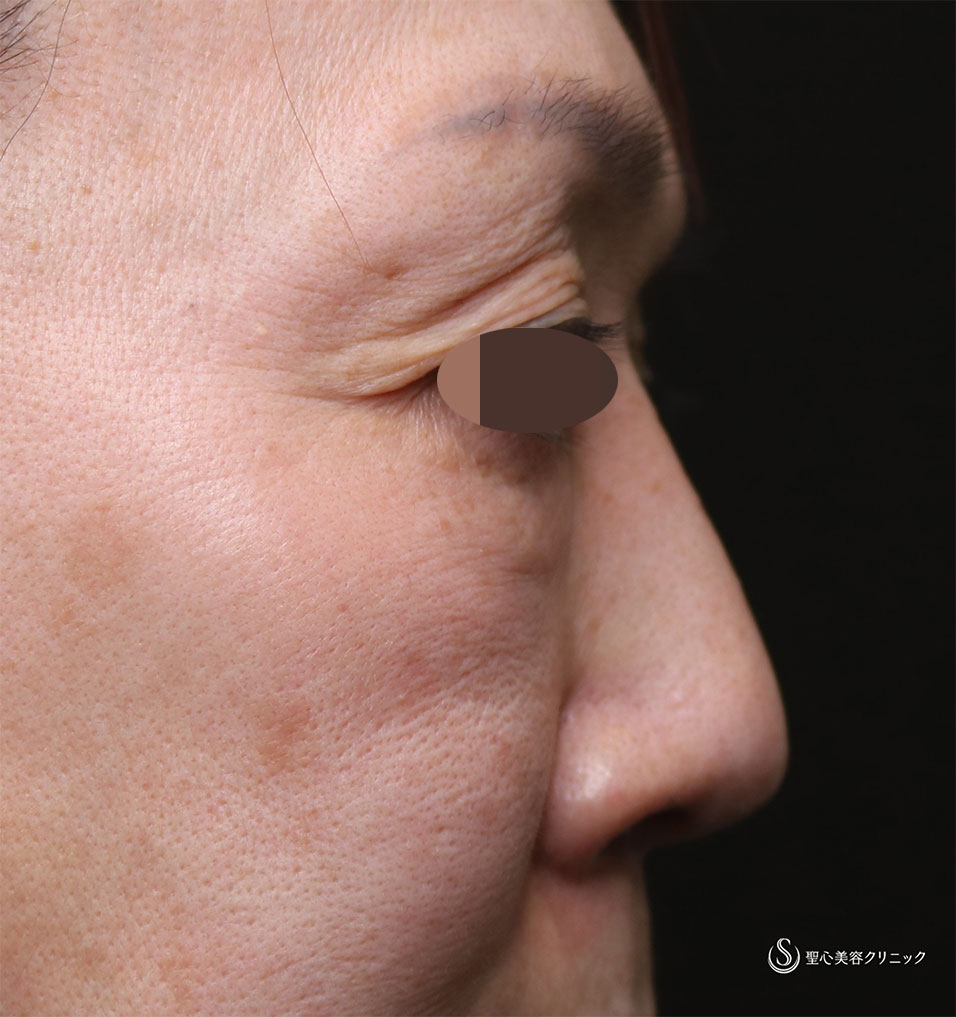 【50代女性・鼻先の形、傷痕】鼻尖形成（3DPCLドーム）（術後2か月） Before 