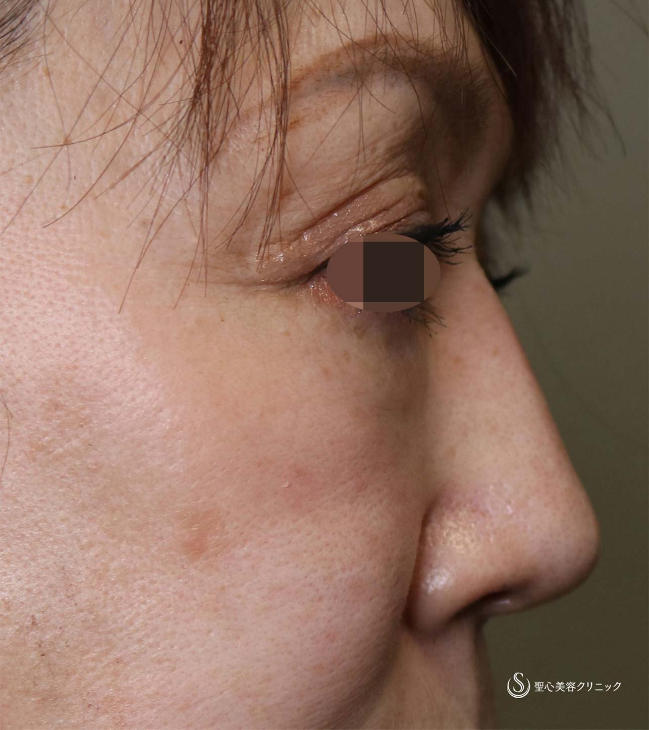 【50代女性・鼻先の形、傷痕】鼻尖形成（3DPCLドーム）（術後2か月） After 