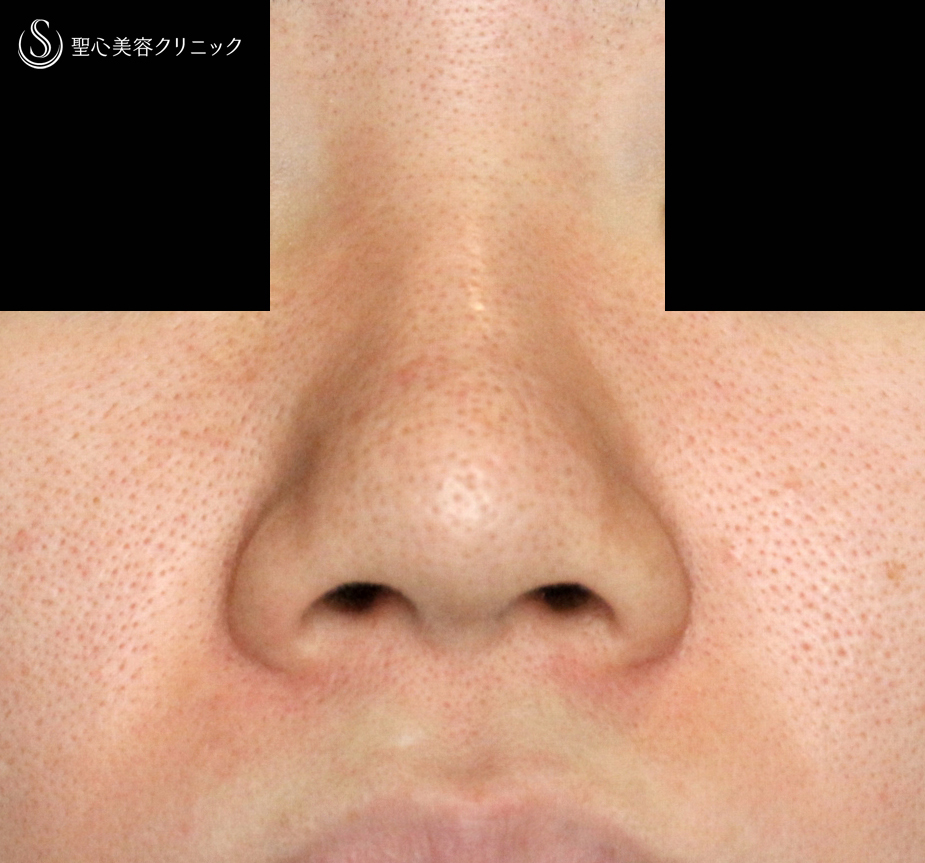 【20代女性・三角形に張り出した特徴的な小鼻をスマートに】小鼻縮小術+α法「Ver.4」単独例（2年7ヶ月） Before 
