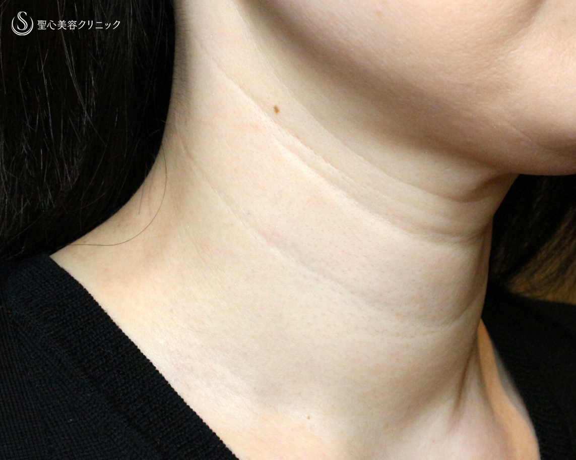 【40代女性・難易度の高い首の横ジワ】プレミアムPRP皮膚再生療法（4年4ヶ月後） Before 