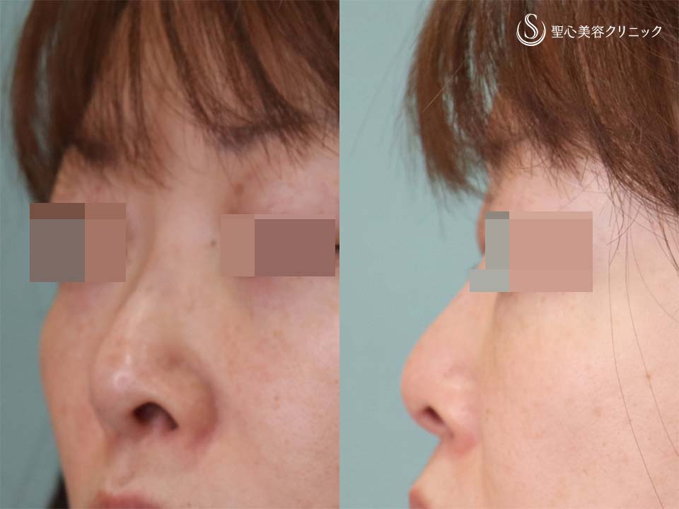 【50代女性・鼻先・鼻孔の形】鼻尖形成（耳介軟骨移植）+鼻孔縁下降術（術後1.5カ月） Before 