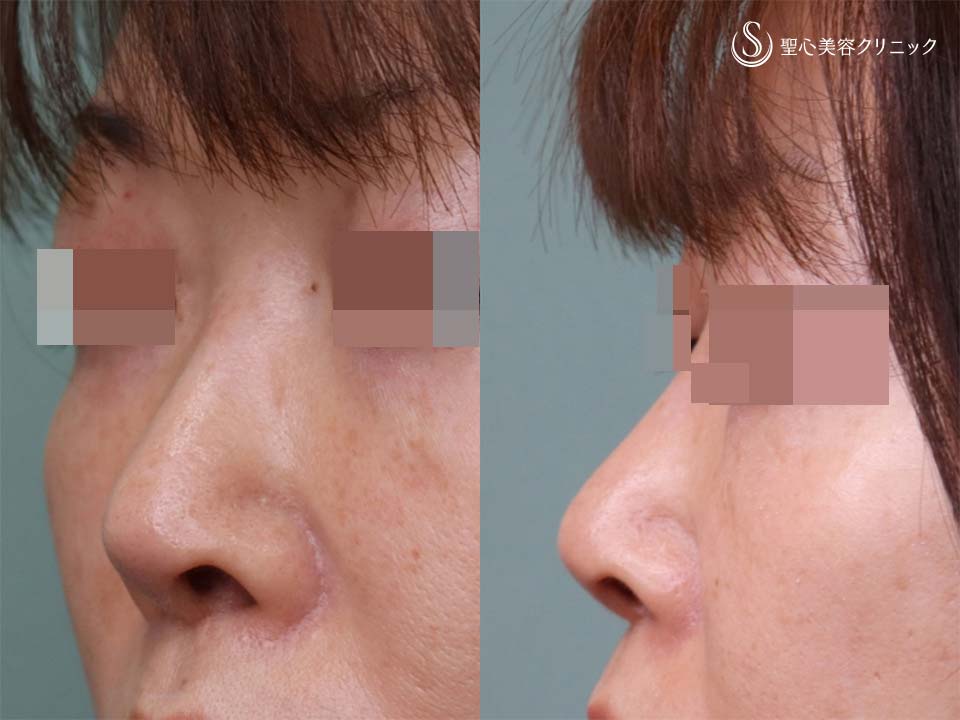 【50代女性・鼻先・鼻孔の形】鼻尖形成（耳介軟骨移植）+鼻孔縁下降術（術後1.5カ月） After 