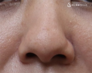 【30代女性・鼻を小さく】鼻尖縮小＋耳介軟骨、小鼻縮小（術後1か月） Before 