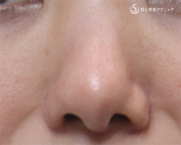 【30代女性・鼻を小さく】鼻尖縮小＋耳介軟骨、小鼻縮小（術後1か月） After 
