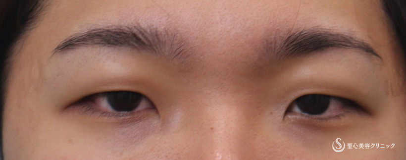 【20代男性・二重】二重切開＋脱脂術（術後1か月） Before 