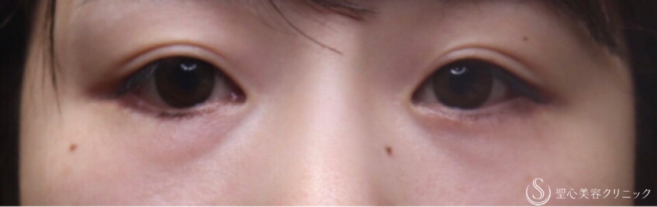 【20代女性・目の下のクマ、膨らみをスッキリ】経結膜下脱脂術（術後1ヶ月） Before 