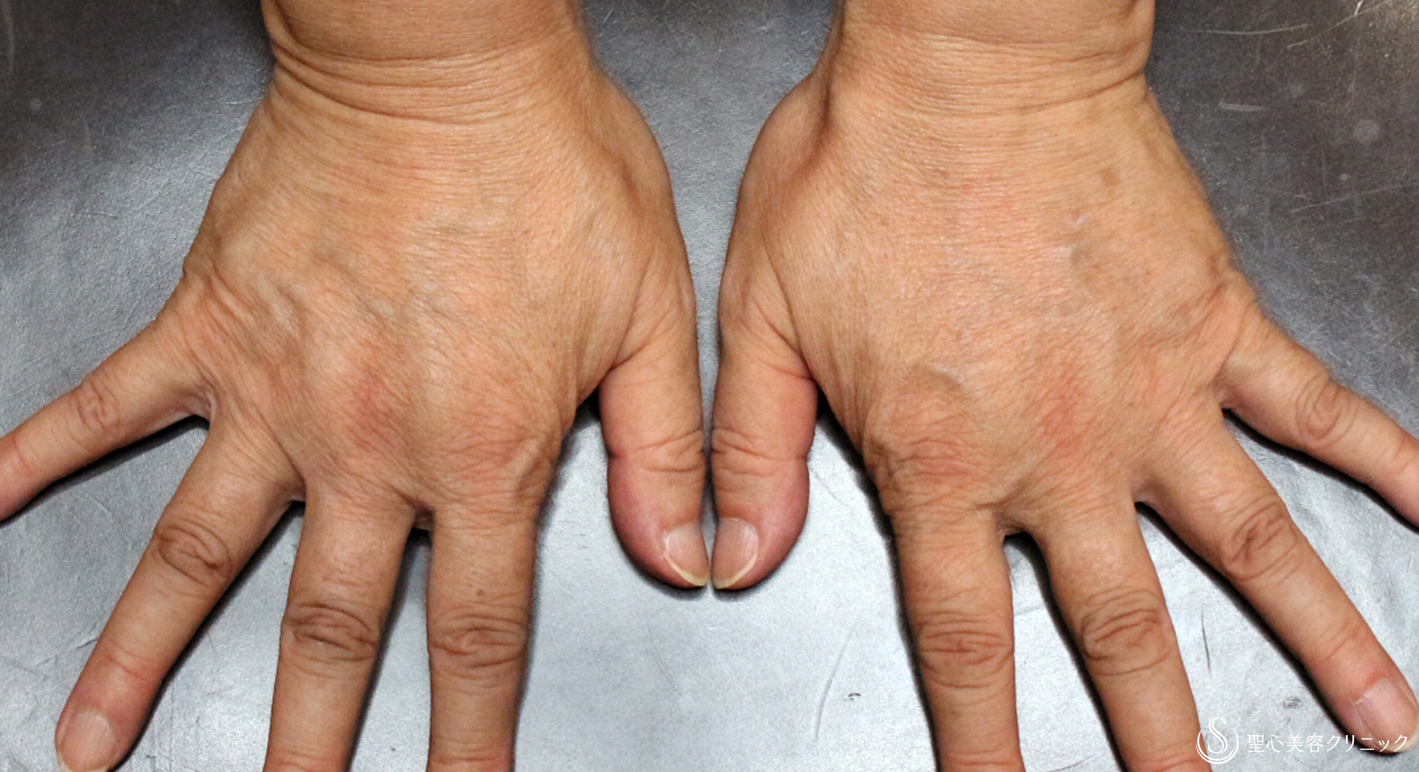 【60代女性・手の甲の若返り】プレミアムPRP皮膚再生療法（8年後） After 